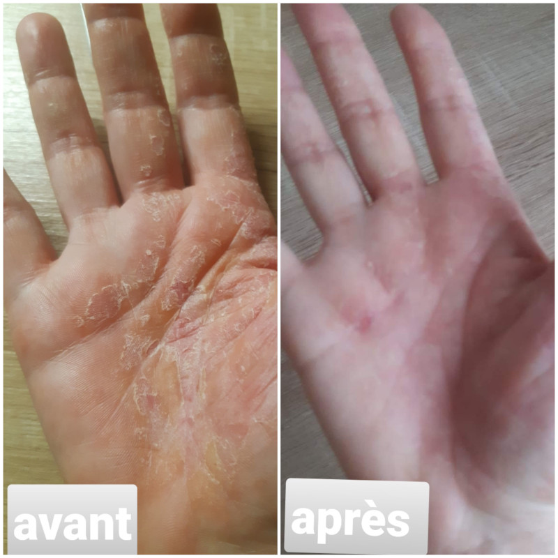 séance de magnétisme sur un psoriasis de mains